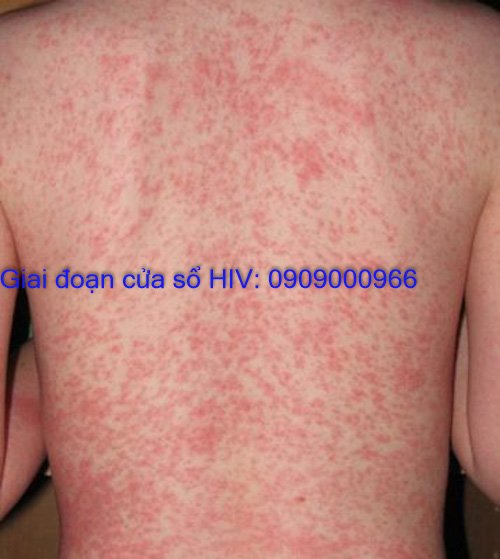 Giai đoạn cửa sổ hiv